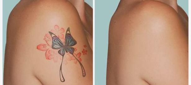 Girne Dövme Silme - Blog yazısı görseli