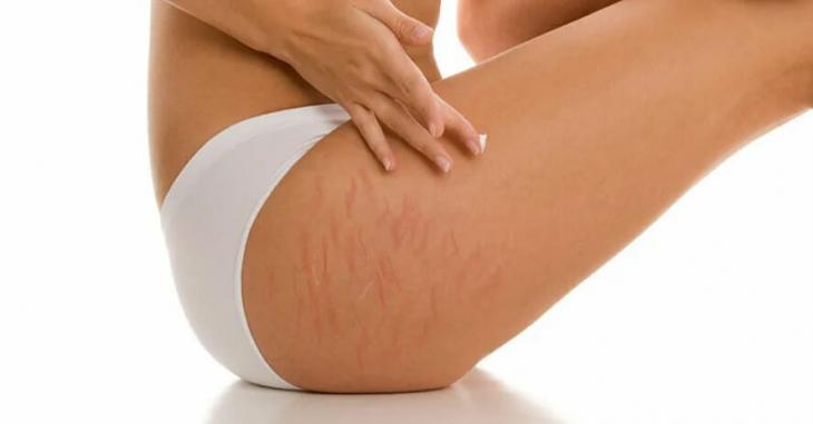 Vücut Çatlaklarına Veda: Girne Çatlak Onarımı ile Pürüzsüz Bir Ten - Blog yazısı görseli