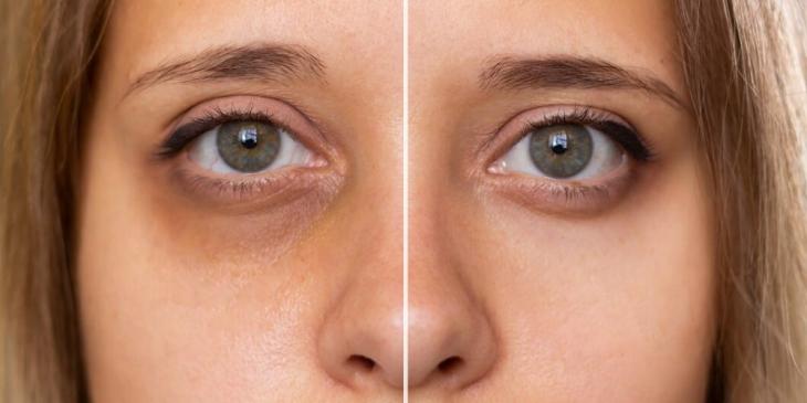 Yorgun Bakışlardan Kurtulun: Girne Göz Altı Morlukları ve Torbalanma Tedavisi - Blog yazısı görseli