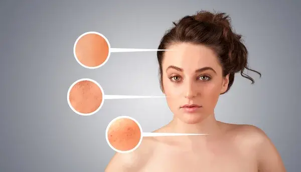 Lekeli Ciltler İçin Bakımlar - Görsel