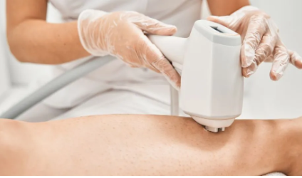 Lazer Epilasyon - Görsel