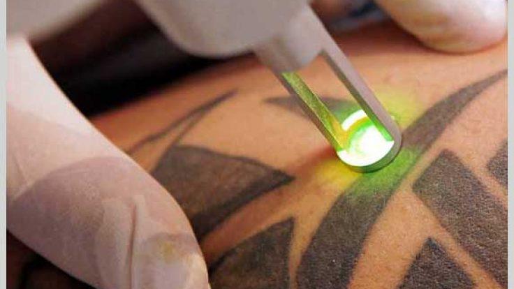 Dövme Silme - Görsel